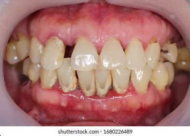 Gingival Recession Known Receding Gums Exposure Stock Photo 2128485983 | Shutterstock