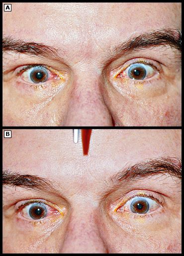 [Figure, Parinaud syndrome Image courtesy: https://commons.wikimedia ...