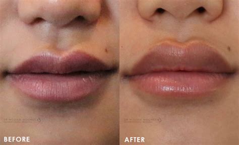 Lip Augmentation & Injections | Sydney | Bondi | Dr Mooney