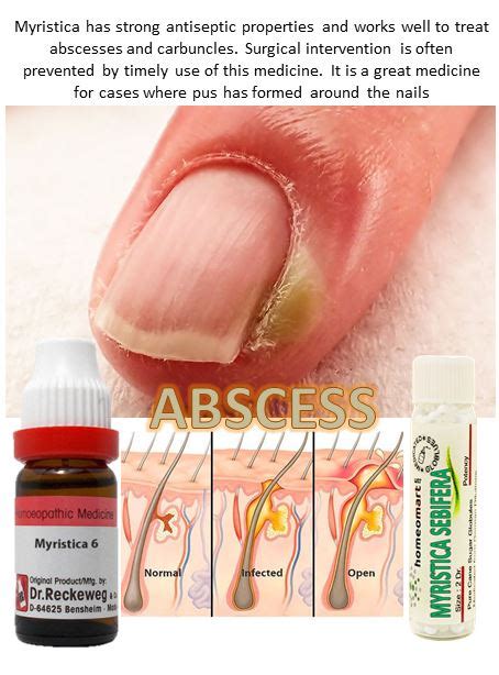 Top doctors recommended Homeopathy Abscess, Boils Treatment Meds