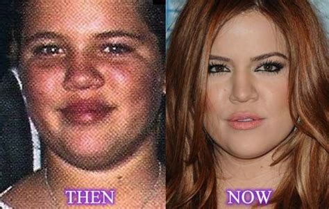 Khloe Kardashian Before And After Nose Job Plastic Surgery | Nose job ...