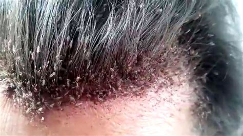 This video of a man's disgusting head lice infestation will make your skin crawl - Irish Mirror ...