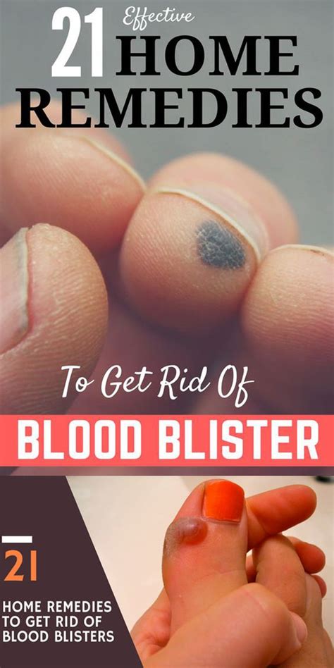 21 Wondrous Home Remedies To Get Rid Of Blood Blisters! - BEAUTIFUL DIY ...