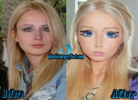 Barbie Woman Plastic Surgery Before And After Photos Plastic Surgery ...