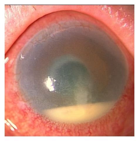 Photograph of the anterior segment in the left eye at the first visit.... | Download Scientific ...