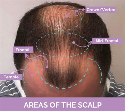 Vertex Thinning Hair