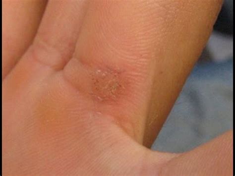 How to Get Rid of Seed Warts - Causes, Symptoms and Remedies - YouTube