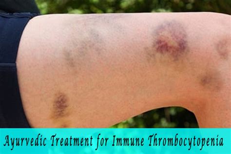 Symptoms of Immune Thrombocytopenia Archives - Planet Ayurveda