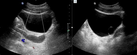 What's the diagnosis? - BJUI