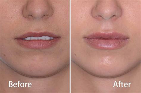 Chin filler before and after - batmanparking