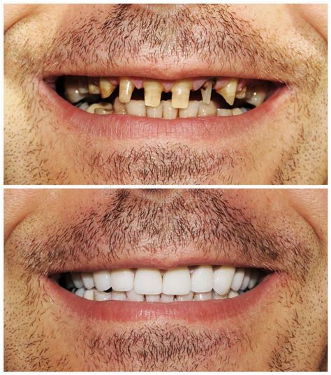 Before and after. Picture of heathy and bad teeth #Sponsored , #ad, # ...