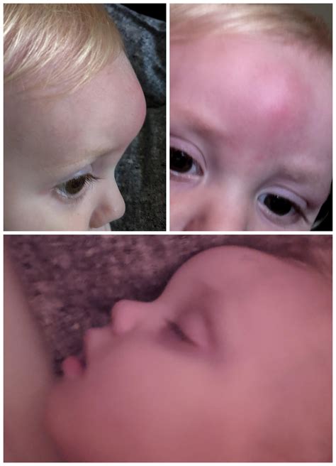 Very swollen forehead from bug bite on 17 month old. We noticed a mosquito bite(?) Two days ago ...