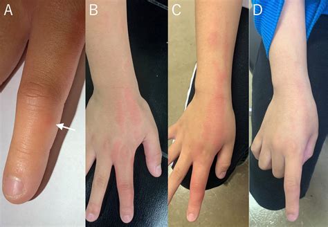 Superficial lymphangitis after arthropod bite: a warning against ...