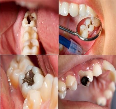 Dental Caries Chart Google Search Dental Decay Dental Caries Dental ...