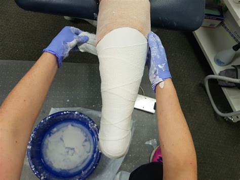 Plaster Casting for Fractures - The Podiatry Group