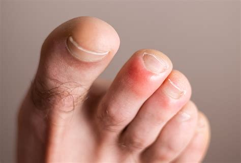 Chilblains: Causes, Symptoms, & Treatment - eMediHealth