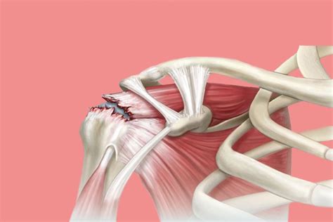 Manguito Rotador: Anatomía, Lesión y Tratamiento - Dr. Javier Severiche - Especialista en ...