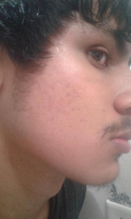 Pitted Acne Scars. – Scar treatments – Acne.org Forum