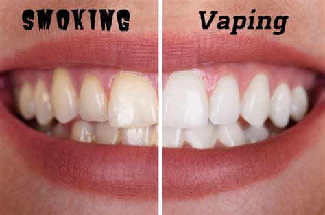 Can Vape Make Your Teeth Yellow - E Cigs And Oral Health Dr Zak Dental ...