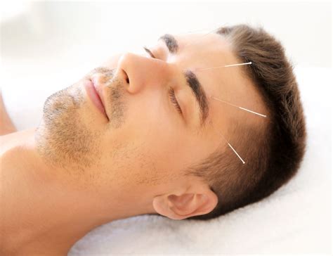 Acupuncture Proven Effective For Migraine Relief