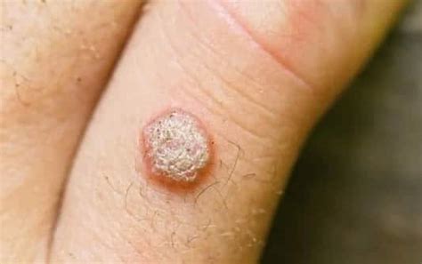 Wondering about Warts? Here's What You Need to Know - Bakersfield ...