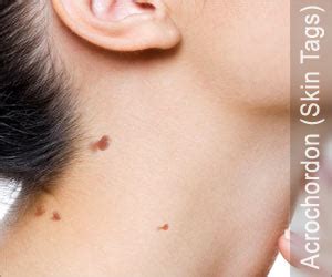 Acrochordon | Skin Tags: Causes Treatment