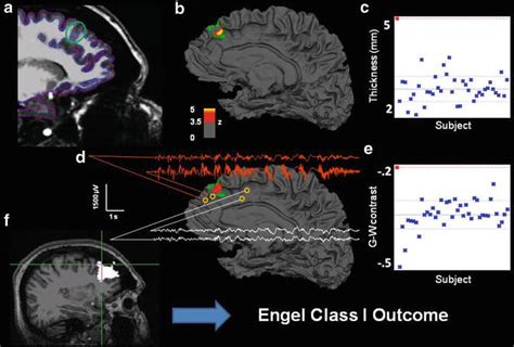 Structural and Quantitative MRI in Epilepsy | Neupsy Key