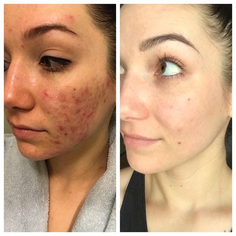 [b&a] Before and 9 months after PDT and Spironolactone : r ...