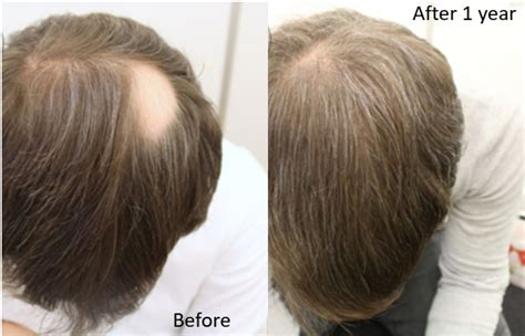 Minoxidil Results After 1 Year - Wimpole Clinic