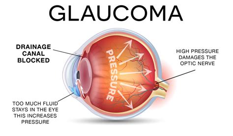 Best Glaucoma Treatment in Mumbai- Infiniti Eye Hospital