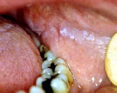 frictional keratosis on tongue