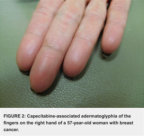 Figure 2 from Capecitabine-Associated Loss of Fingerprints: Report of Capecitabine-Induced ...