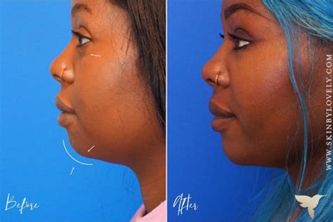 Dermal Fillers with Before & After Photos - Skin by Lovely