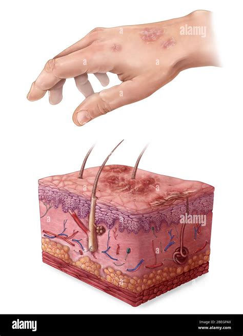 Mild psoriasis hi-res stock photography and images - Alamy