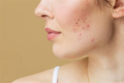 Hormonal Acne 101: How It Happens & How To Treat It