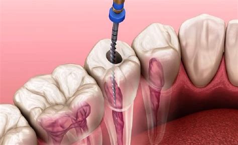 √ Proses Perawatan Saluran Akar Gigi yang Perlu Diketahui - HargaBulanIni.com
