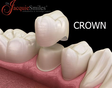 How to Choose a Dentist for Crowns in NYCDr. Jacquie