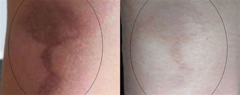 Burn Scar Laser Treatment - Connecticut Skin Institute