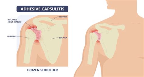 Frozen Shoulder Injection: What You Need to Know Sport Doctor London