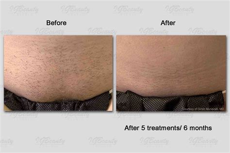 Brazilian Laser Hair Removal Before And After Photos - Hair Style Blog