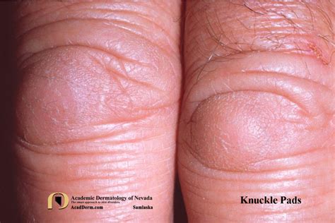 Knuckle Pads: Heloderma... - Academic Dermatology of Nevada