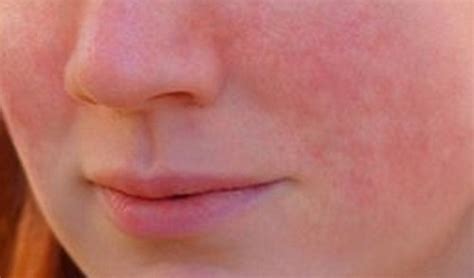 Stress Rash Pictures | Medical Pictures and Images - (2023 Updated)