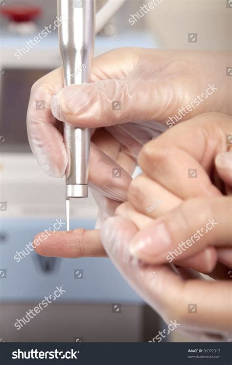 Laser Removal Wart Stock Photo 96372317 | Shutterstock