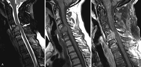 Spinal Stenosis: Cervical | Radiology Key