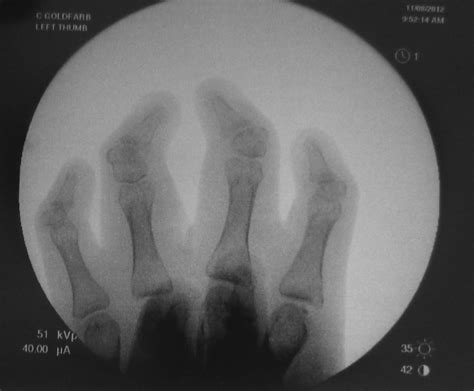 Carpenter Syndrome | Congenital Hand and Arm Differences | Washington ...