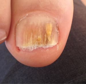 Do You Have A Dead Toenail? - Podiatry HQ Clinics