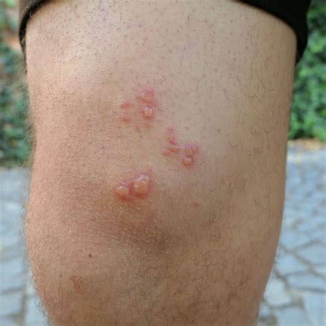 14 Common Bug Bites - Identifying Insect Bites Pictures | BodyBalancee.com