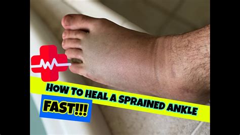 Heal A Sprained Ankle FAST! | Skate School 86 - YouTube