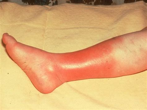 Cellulitis - Pictures, Symptoms, Treatment, Contagious, Causes, Types - HubPages