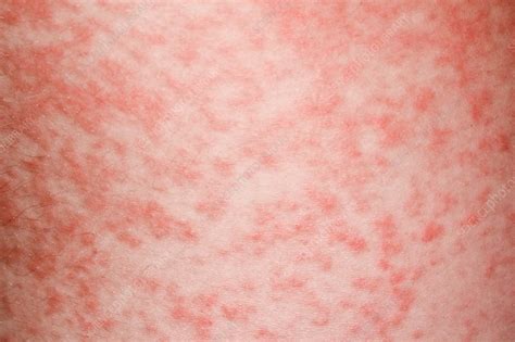 Amoxicillin rash in glandular fever - Stock Image - C034/5320 - Science Photo Library